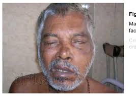 PDF) Malignant otitis externa a review of current literature Difficult to  diagnose and troublesome to treat