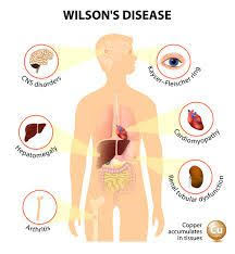Wilson Disease Leads To Damage To Liver And Basal Ganglia Wilson S Disease Disease Symptoms Disease