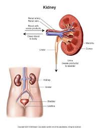Kidney Stones Affect Approximately 1 In 11 People In The United States Anyone Can Get One But Some People Are More Likely T Chronic Kidney Disease