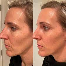 It is often permanent and can be attributed to heredity. Collagen Elixir Marine Collagen Peptides Isagenix