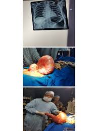 Image result for Sigmoid Volvulus