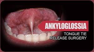 Image result for Ankyloglossia