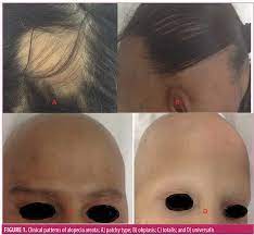Ancak, bazı tedaviler bazı insanların saçlarını yeniden. The Role Of Dermoscopy In Severity Assessment Of Alopecia Areata A Tertiary Care Center Study Jcad The Journal Of Clinical And Aesthetic Dermatology