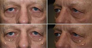 Festoon vs. Lower Eyelid Dermatochalasis