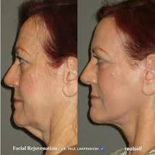 How To Tighten Your Neck Neck Lift Sagging Neck Skin Turkey Neck