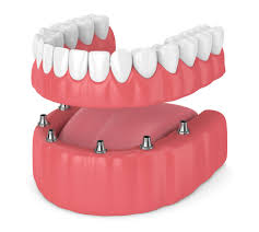 Most dentists can take an impression but the qualifier here is that it needs to be evaluated for the impression it just took. Full Dentures Vs Partials Steve Hagerman Dds Pc