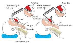 Dấu hiệu ung thư vòm họng giai đoạn sớm rất mơ hồ, dễ nhầm lẫn nên thường chỉ phát hiện bệnh ở giai đoạn nặng, gây nhiều khó khăn trong điều trị. Ung ThÆ° Háº¡ Há»ng Giai Ä'oáº¡n 3 Co Thá»ƒ Thao á»'ng Ná»™i Khi Quáº£n Khong Vinmec