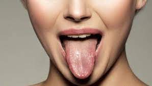 HCMT on Twitter: "#DİL RENGİNDEN HANGİ HASTALIKLARI TEŞHİS  EDEBİLİRİZ...👇👇👇 -Kalın beyaz pas: Üşütme, bağırsak sistemindeki  düzensizlik. -Beyaz sarımsı pas: Kronik mide iltihabı -Dilde diş izleri,  pas lekesi: Sindirim sistemi sorunları. -Kahverengi dil: