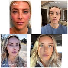 Has anybody in this group had personal experience with Dr. Lazaro Cardenas  in Guadalajara? I am scheduled for facial surgery December 5th (facelift,  rhinoplasty, blephraplasty) and if so, would you mind sharing