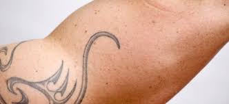 Tattoo dyes — especially red, green, yellow and blue dyes — can cause allergic skin reactions, such as an itchy rash at the tattoo site. Does Laser Tattoo Removal Cause Skin Cancer Premium Tattoo Removal