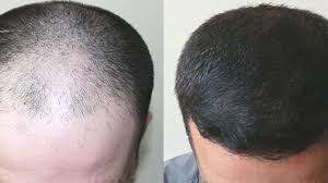 Si definisce autologo perché i capelli trapiantati sono prelevati dal . Trapianto Capelli Occhio A Offerte Low Cost Su Web Ilfogliettone Itilfogliettone It