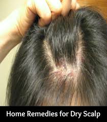 Home Remedies For Dry Scalp Scalp Acne Dry Scalp Remedy Scalp Scabs