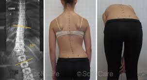 Masalah sakit belakang berpunca daripada bahagian tulang belakang dan tulang pinggul tertentu yang tidak berada di dalam kedudukan yang sepatutnya. Jangan Abaikan 5 Tanda Ini Mungkin Anda Mengalami Tulang Bengkok Atau Scoliosis