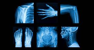 Die entzündung des rheumas kann durch den blutfluss auch die inneren organe befallen. Eular 2017 Neues Bei Rheuma Medmix