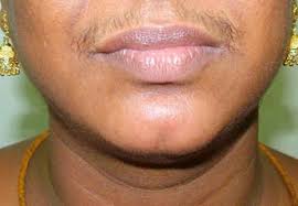 Carlos charles also cites genetics as a reason for chin hair. Why Grow Chin Hairs In Women Causes Treatment