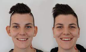 Check spelling or type a new query. Ohrenkorrektur Abstehende Ohren Korrigieren Ohrmuscheln Operieren Abstehende Ohren Anlegen Operation Risiken Kosten Vor Und Nachher