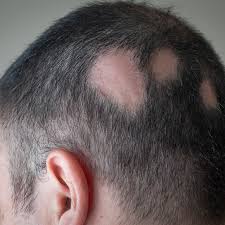 There's no doubt about it, we all want a luxurious, full head of hair. Natural Treatments For Alopecia Areata
