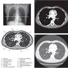 Chest Ct Ct Scan Medical Ultrasound Diagnostic Imaging