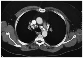 Image result for Broncholithiasis