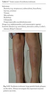 Image result for erythema nodosum