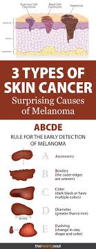 What does skin cancer look like? Melanoma Research