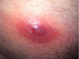 They are red and swollen the majority of the time and even filled with pus. Ingrown Hair In Private Area How Qmog Fi