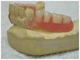 Jangan kira kalau sudah implan pasti berhasil ya. Quality Dental Protesa At Ortho Lab Solution
