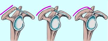 Classe bigliani (it) guardacoste classe bigliani, classe bigliani (guardacoste) (it). Impingement Syndrom Schulter Ausg 13 Klinik Am Ring