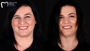 Digital smile design and natural teeth libraries