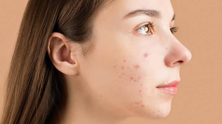 Acne: Understanding Causes, Treatments, and Prevention Strategies for  Clearer Skin | Skin Solutions Dermatology and Cosmetics