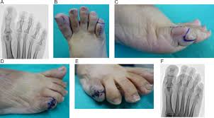 Image result for toe amputation