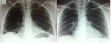 Shrinking Lung Syndrome In Systemic Lupus Erythematosus Department Of Internal Medicine La Rabta University Hospital
