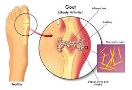Indian Diet Plan For Gout What To Eat And Avoid In Gout