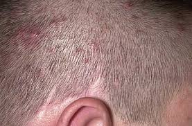 Remedies For Pimples On Scalp Scalp Remedies Pimples On Scalp Scalp Acne Sores On Scalp