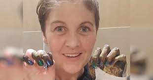 Meningitis and sepsis change my life in an instant