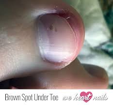 brown spots under toenail causes