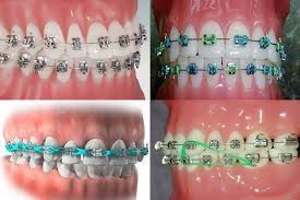 Discover the most modern transparent aligner system worldwide and transform your smile. How Braces Work To Straighten Your Teeth