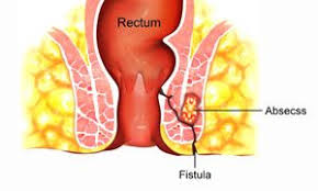 Image result for Perirectal Abscess