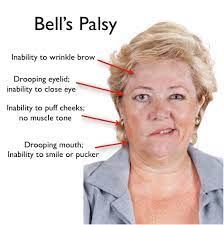 Lalu, apa sebenarnya penyakit bell's palsy itu? Jemari Magis Bonda Apa Itu Bell Palsy