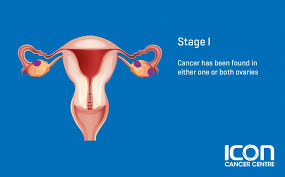 The ovaries are a pair of organs in the female reproductive system, located on each side of the uterus. Ovarian Cancer Signs Symptoms Icon Centre Singapore