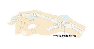 In many cases, the cysts go away on their own. Ganglion Cyst Circle Integrated Care