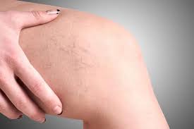 All You Need To Know About Vein Treatments Health Fitness