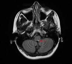 Multiple sclerosis splenium demyelination immune. Cureus Isolated Area Postrema Syndrome Presenting As Intractable Nausea And Vomiting