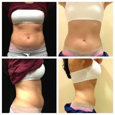 Pictures Of Cool Sculpting Before And After Body Sculpting Is A Great Alternative To Liposuction Or Surgery Cool Body Sculpting Cool Sculpting Body Sculpting