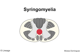 Image result for Syringomyelia