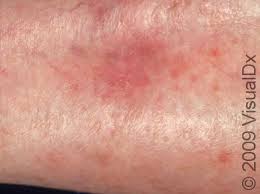 Image result for Lichen Simplex Chronicus