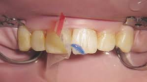 Dürr dental gmbh & co. Treating Dental Trauma Decisions In Dentistry