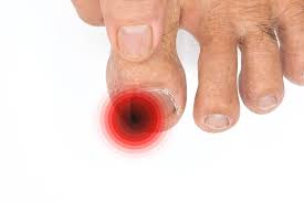 Image result for Paronychia feet