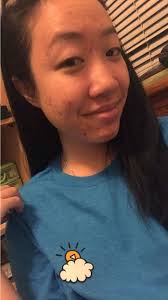 I Tried Tea Tree Oil For Acne And It Actually Worked