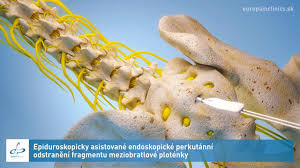 Image result for vyhřezlá ploténka